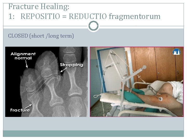 Fracture Healing: 1: REPOSITIO = REDUCTIO fragmentorum CLOSED (short /long term) 