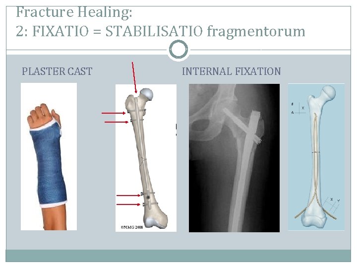 Fracture Healing: 2: FIXATIO = STABILISATIO fragmentorum PLASTER CAST INTERNAL FIXATION 