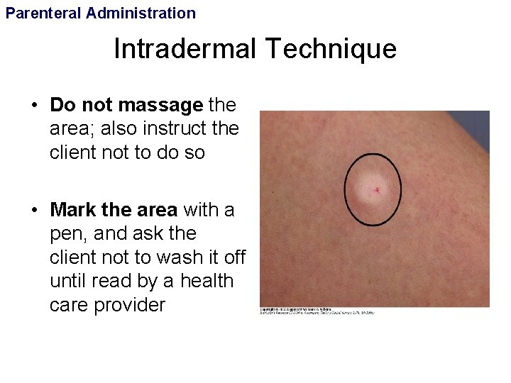 Parenteral Administration Intradermal Technique • Do not massage the area; also instruct the client