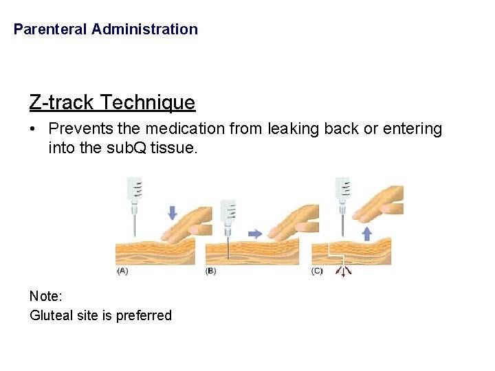 Parenteral Administration Z-track Technique • Prevents the medication from leaking back or entering into