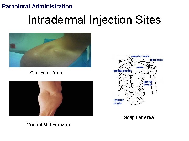 Parenteral Administration Intradermal Injection Sites • Clavicular Area Scapular Area Ventral Mid Forearm 