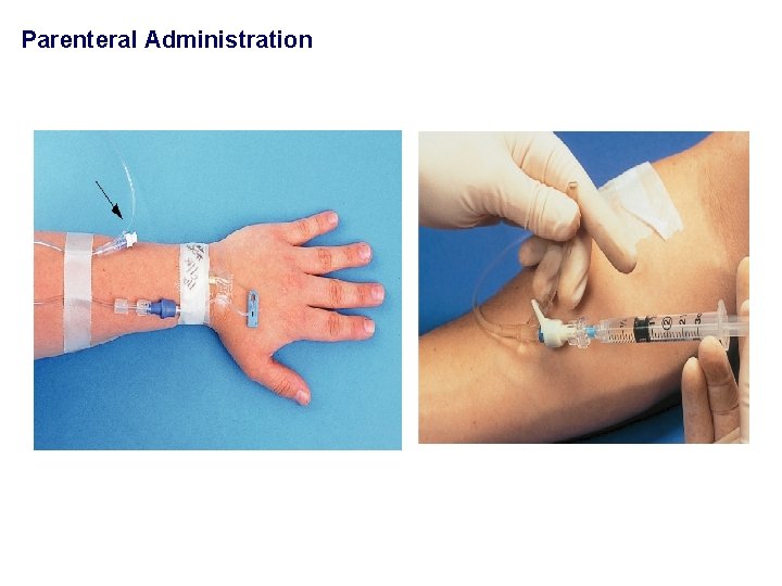 Parenteral Administration 