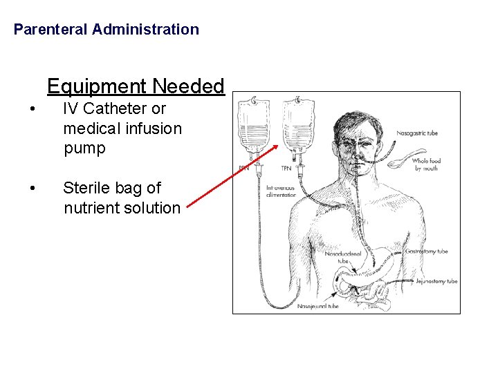 Parenteral Administration Equipment Needed • IV Catheter or medical infusion pump • Sterile bag