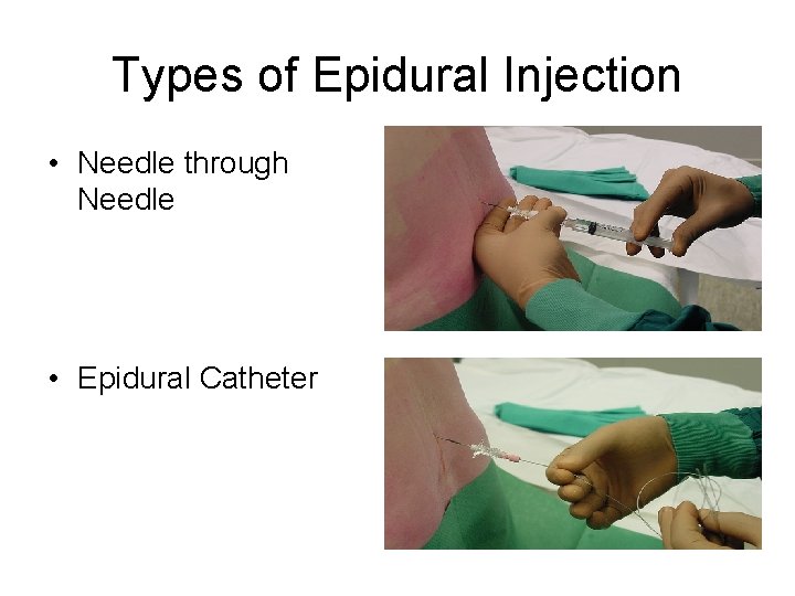 Types of Epidural Injection • Needle through Needle • Epidural Catheter 