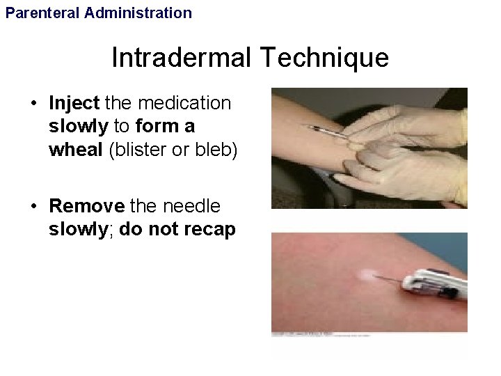 Parenteral Administration Intradermal Technique • Inject the medication slowly to form a wheal (blister