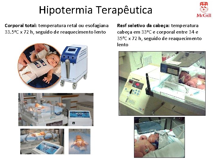Hipotermia Terapêutica Corporal total: temperatura retal ou esofagiana 33. 5 o. C x 72