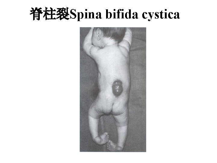 脊柱裂Spina bifida cystica 