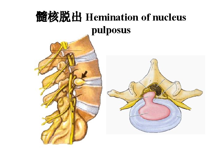 髓核脱出 Hemination of nucleus pulposus 