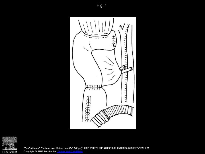 Fig. 1 The Journal of Thoracic and Cardiovascular Surgery 1997 113975 -981 DOI: (10.