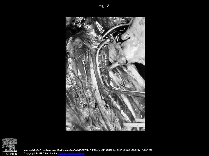 Fig. 2 The Journal of Thoracic and Cardiovascular Surgery 1997 113975 -981 DOI: (10.