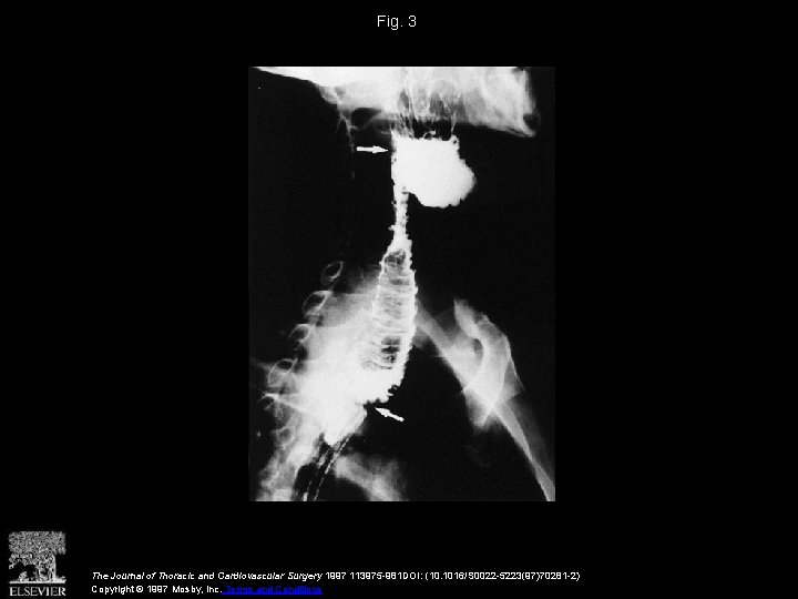 Fig. 3 The Journal of Thoracic and Cardiovascular Surgery 1997 113975 -981 DOI: (10.