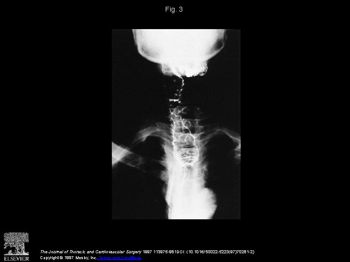 Fig. 3 The Journal of Thoracic and Cardiovascular Surgery 1997 113975 -981 DOI: (10.