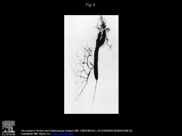 Fig. 4 The Journal of Thoracic and Cardiovascular Surgery 1997 113975 -981 DOI: (10.