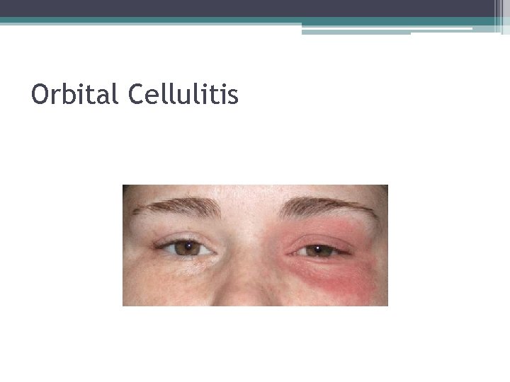 Orbital Cellulitis 