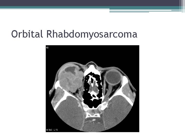 Orbital Rhabdomyosarcoma 