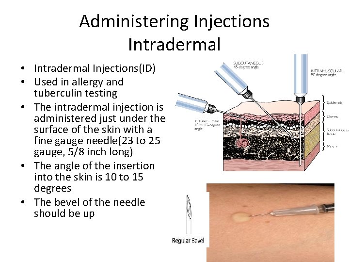 Administering Injections Intradermal • Intradermal Injections(ID) • Used in allergy and tuberculin testing •