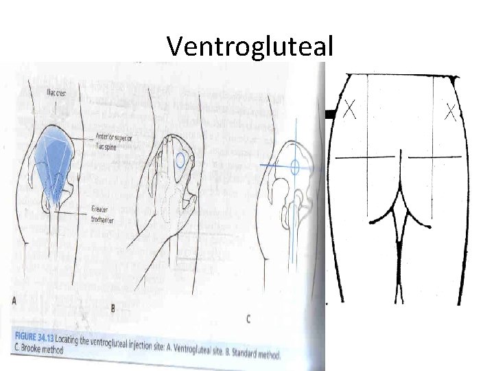 Ventrogluteal 