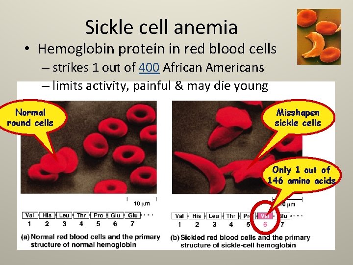 Sickle cell anemia • Hemoglobin protein in red blood cells – strikes 1 out