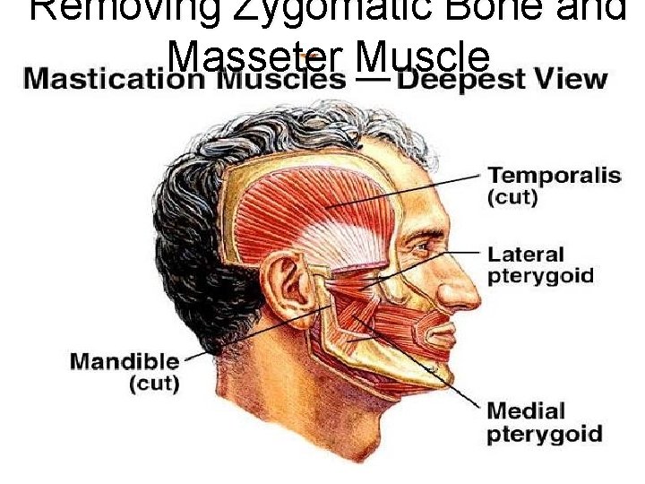 Removing Zygomatic Bone and Masseter Muscle 