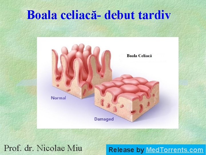 Boala celiacă- debut tardiv Prof. dr. Nicolae Miu Release by Med. Torrents. com 
