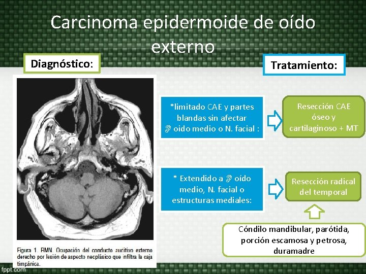 Carcinoma epidermoide de oído externo Diagnóstico: TAC Tratamiento: *limitado CAE y partes blandas sin Carcinoma epidermoide de oído externo Diagnóstico: TAC Tratamiento: *limitado CAE y partes blandas sin