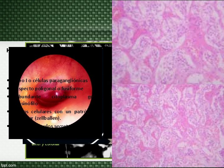 Histopatología: • • • tipo I o células paragangliónicas Aspecto poligonal o fusiforme Abundante Histopatología: • • • tipo I o células paragangliónicas Aspecto poligonal o fusiforme Abundante