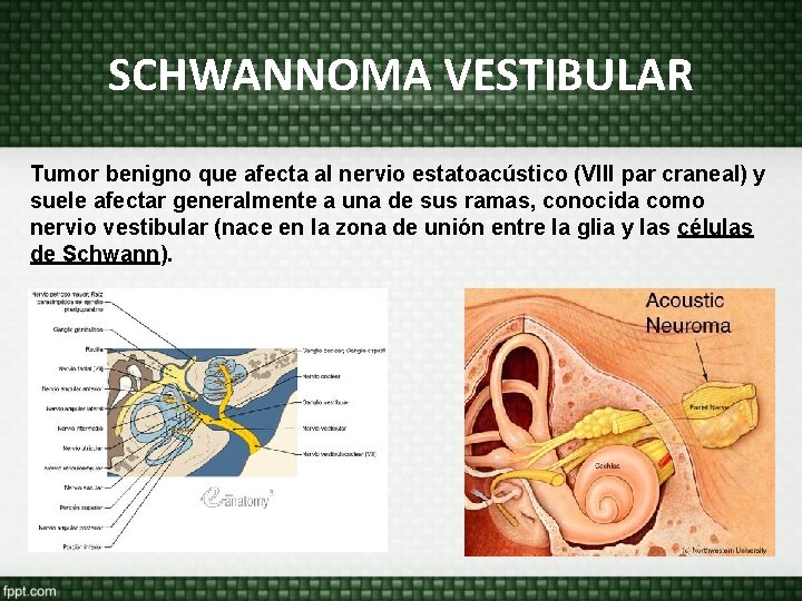 SCHWANNOMA VESTIBULAR Tumor benigno que afecta al nervio estatoacústico (VIII par craneal) y suele SCHWANNOMA VESTIBULAR Tumor benigno que afecta al nervio estatoacústico (VIII par craneal) y suele
