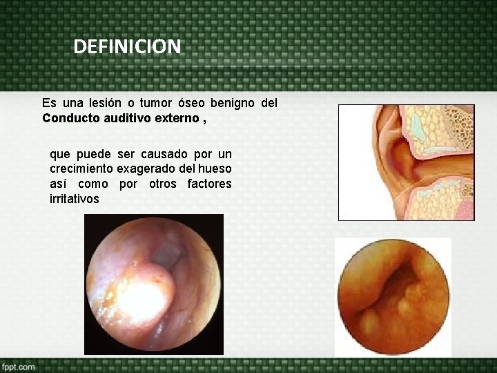 DEFINICION Es una lesión o tumor óseo benigno del Conducto auditivo externo , que DEFINICION Es una lesión o tumor óseo benigno del Conducto auditivo externo , que