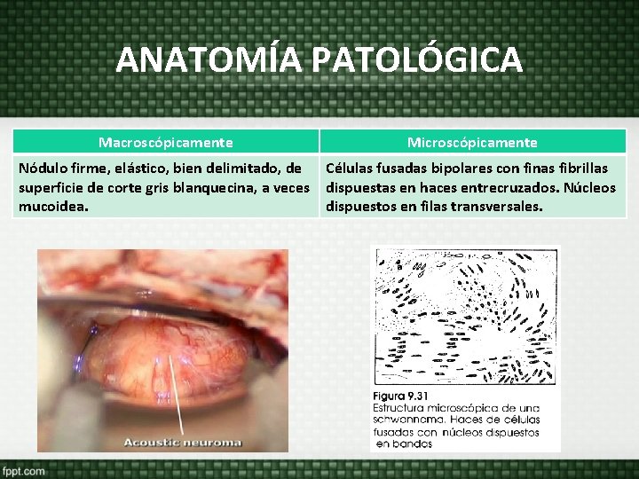 ANATOMÍA PATOLÓGICA Macroscópicamente Microscópicamente Nódulo firme, elástico, bien delimitado, de superficie de corte gris ANATOMÍA PATOLÓGICA Macroscópicamente Microscópicamente Nódulo firme, elástico, bien delimitado, de superficie de corte gris