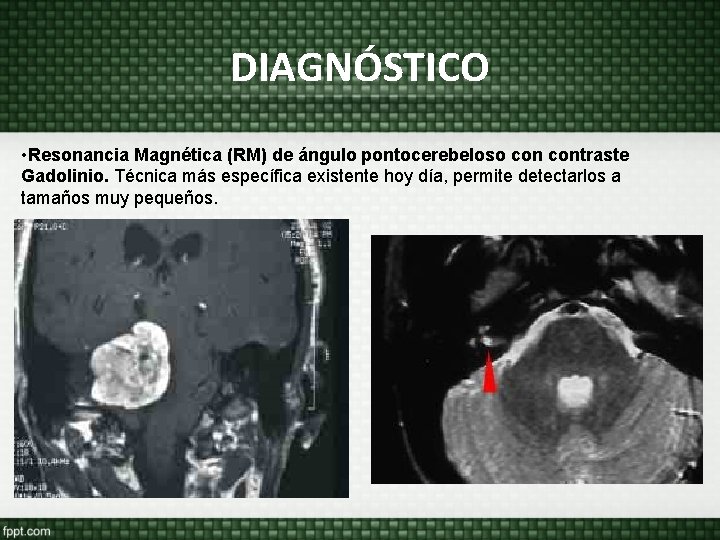 DIAGNÓSTICO • Resonancia Magnética (RM) de ángulo pontocerebeloso contraste Gadolinio. Técnica más específica existente DIAGNÓSTICO • Resonancia Magnética (RM) de ángulo pontocerebeloso contraste Gadolinio. Técnica más específica existente