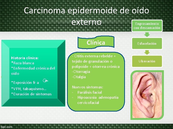 Carcinoma epidermoide de oído externo Engrosamiento con descamación Clínica Historia clínica: *Raza blanca -*Enfermedad Carcinoma epidermoide de oído externo Engrosamiento con descamación Clínica Historia clínica: *Raza blanca -*Enfermedad