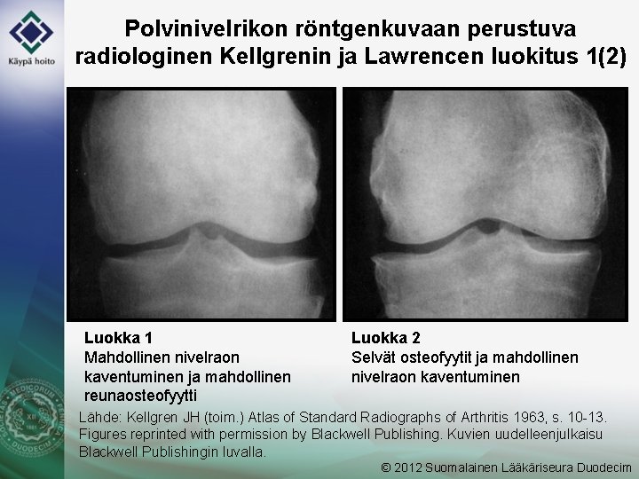 Polvinivelrikon röntgenkuvaan perustuva radiologinen Kellgrenin ja Lawrencen luokitus 1(2) Luokka 1 Mahdollinen nivelraon kaventuminen