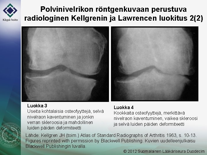 Polvinivelrikon röntgenkuvaan perustuva radiologinen Kellgrenin ja Lawrencen luokitus 2(2) Luokka 3 Useita kohtalaisia osteofyyttejä,