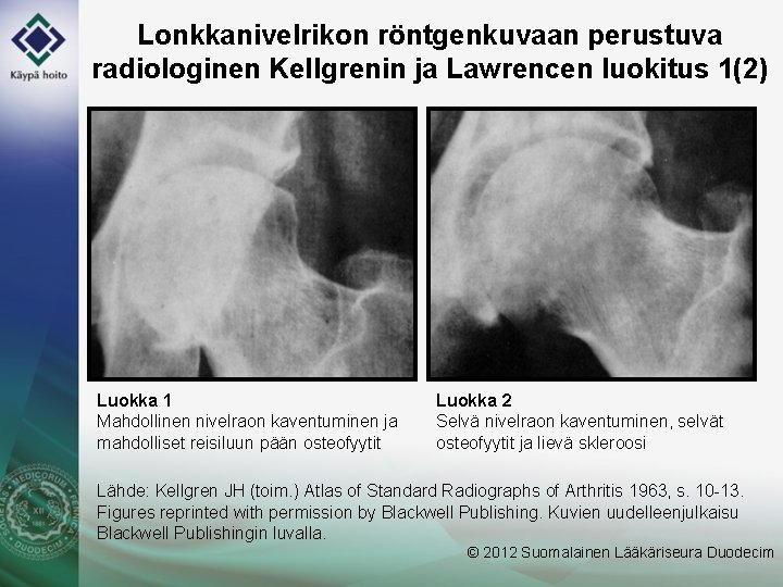 Lonkkanivelrikon röntgenkuvaan perustuva radiologinen Kellgrenin ja Lawrencen luokitus 1(2) Luokka 1 Mahdollinen nivelraon kaventuminen