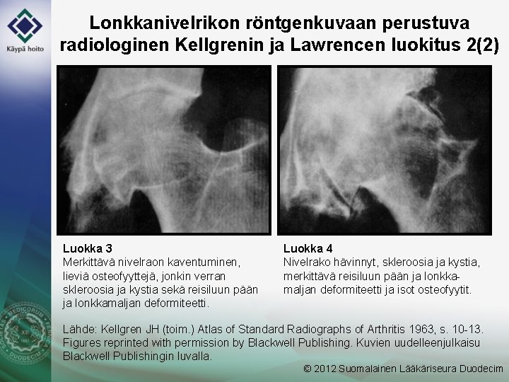 Lonkkanivelrikon röntgenkuvaan perustuva radiologinen Kellgrenin ja Lawrencen luokitus 2(2) Luokka 3 Merkittävä nivelraon kaventuminen,