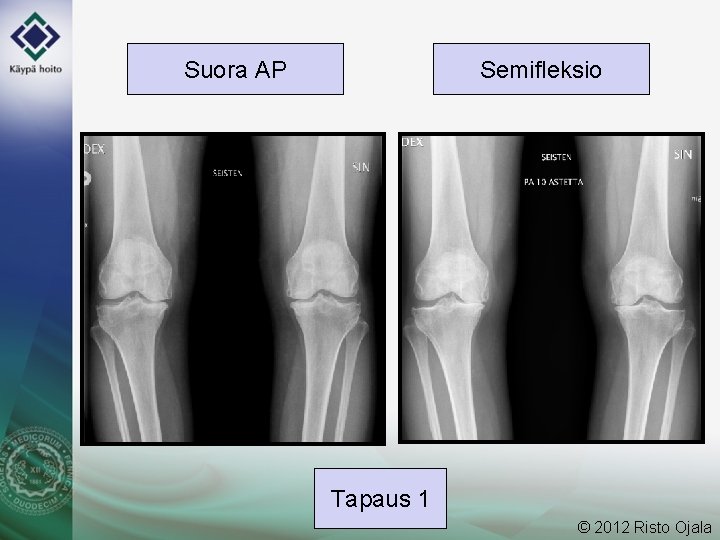 Suora AP Semifleksio Tapaus 1 © 2012 Risto Ojala 