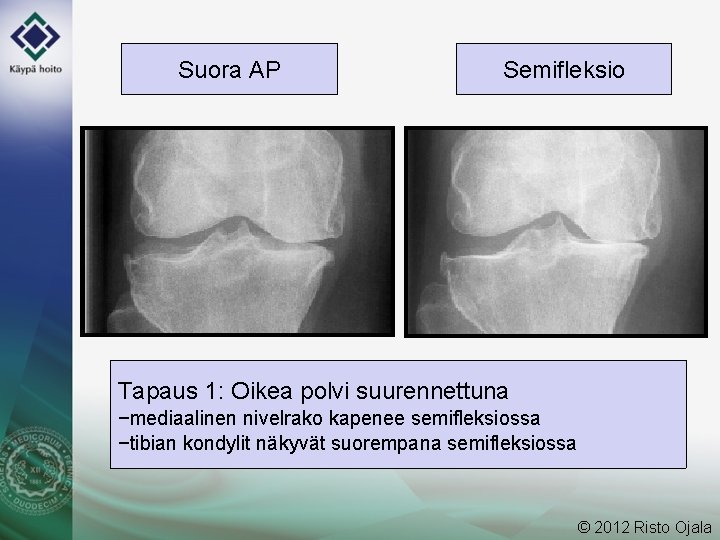 Suora AP Semifleksio Tapaus 1: Oikea polvi suurennettuna −mediaalinen nivelrako kapenee semifleksiossa −tibian kondylit