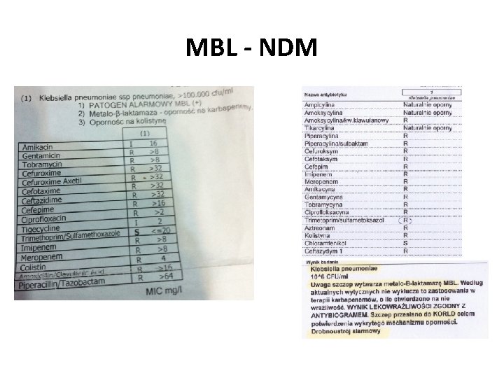 MBL - NDM 