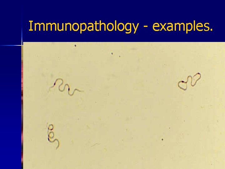 Immunopathology - examples. n Cerebral malaria - TNF, IFN & other proinflammatory cytokines in