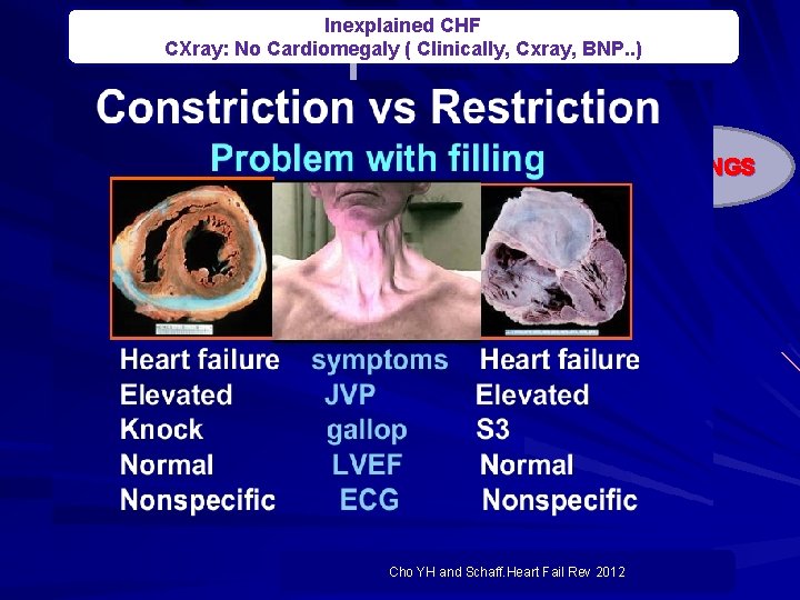 Inexplained CHF CXray: No Cardiomegaly ( Clinically, Cxray, BNP. . ) Echo: Normal LV