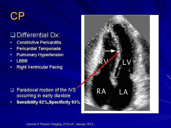 CP q Differential Dx: § § § Constrictive Pericarditis Pericardial Tamponade Pulmonary Hypertension LBBB