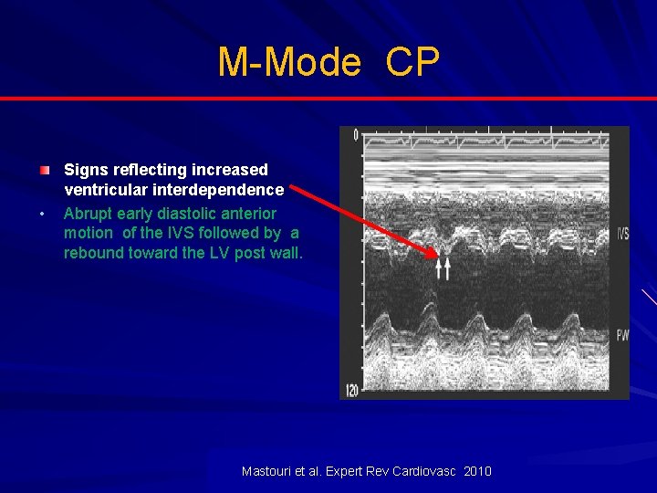 M-Mode CP • Signs reflecting increased ventricular interdependence Abrupt early diastolic anterior motion of