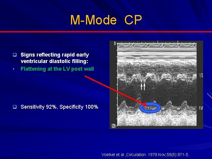 M-Mode CP q Signs reflecting rapid early • ventricular diastolic filling: Flattening at the