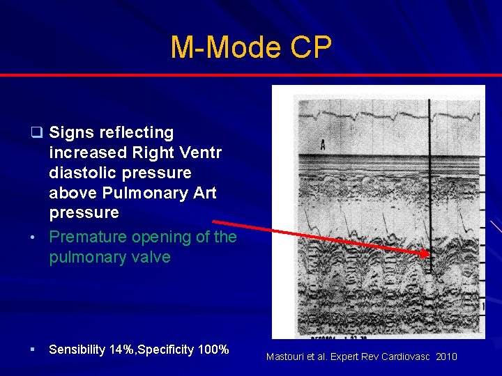M-Mode CP q Signs reflecting increased Right Ventr diastolic pressure above Pulmonary Art pressure