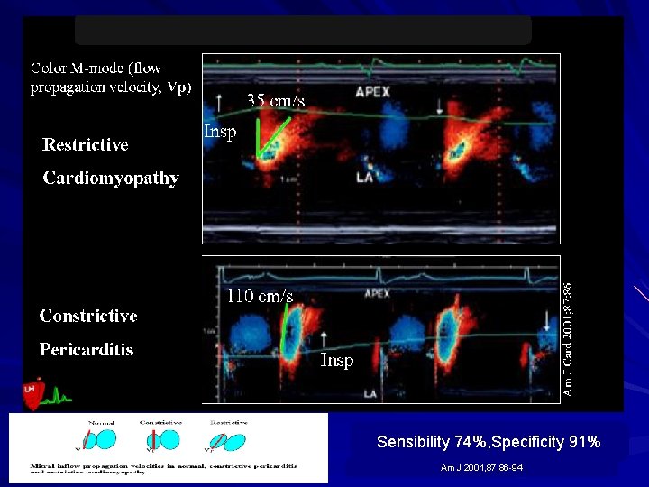 Sensibility 74%, Specificity 91% Am J 2001, 87, 86 -94 