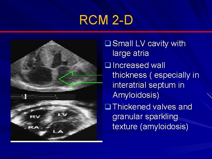 RCM 2 -D q Small LV cavity with large atria q Increased wall thickness