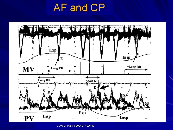 AF and CP J Am Coll Cardio 2001; 37: 1936 -42 