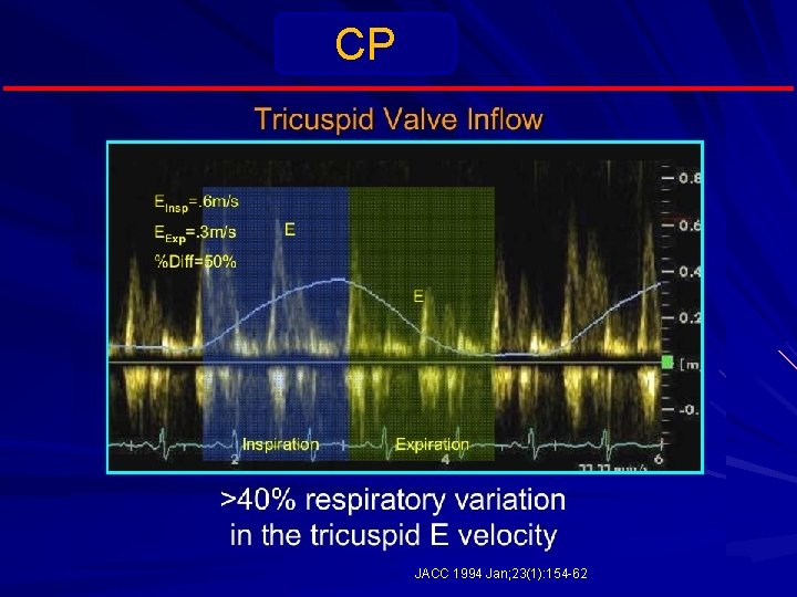 CP JACC 1994 Jan; 23(1): 154 -62 