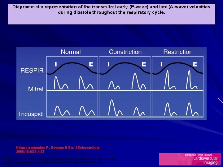 Diagrammatic representation of the transmitral early (E-wave) and late (A-wave) velocities during diastole throughout
