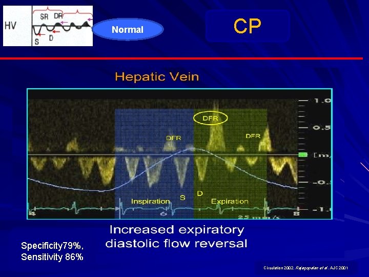 Normal CP Specificity 79%, Sensitivity 86% Circulation 2002, Rajagopalan et al. AJC 2001 